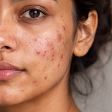 Oil & Acne Control
